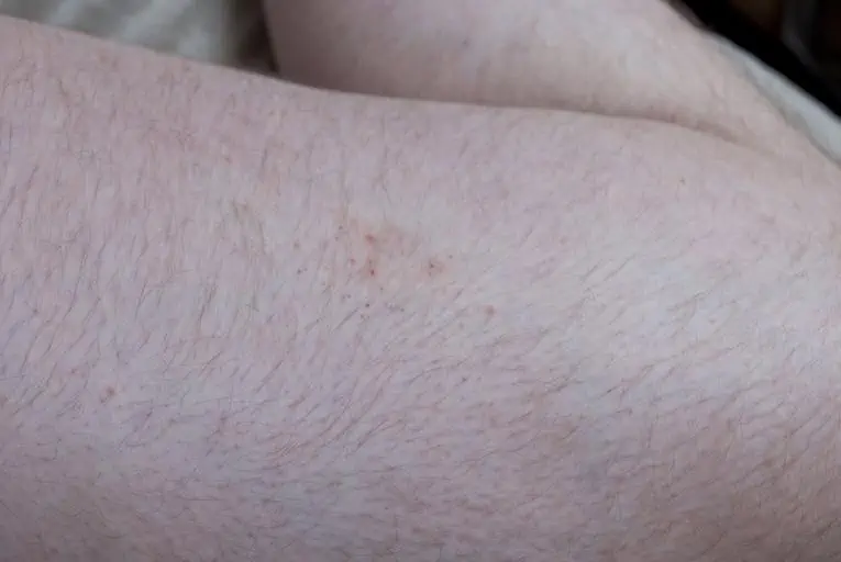 3 bat bug bite